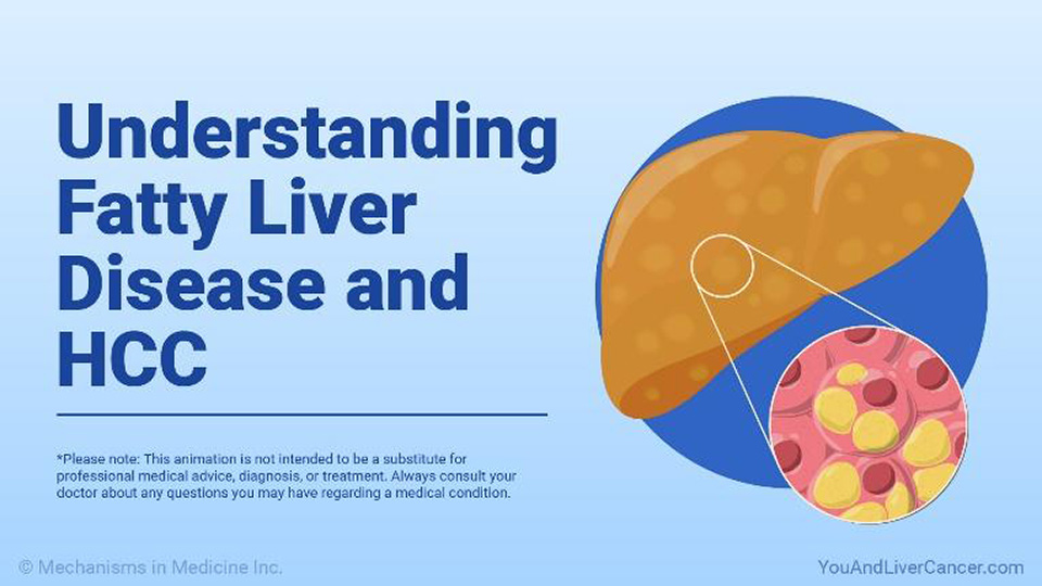 Understanding Fatty Liver Disease and HCC