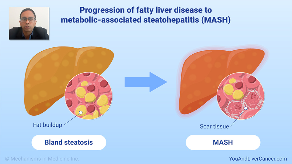 What is metabolic-associated steatohepatitis (MASH) and how is it diagnosed? 